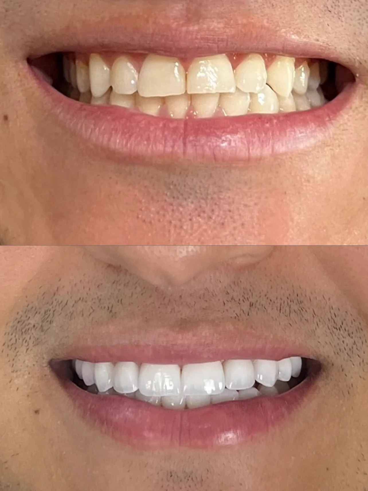 Comparativo de resultado odontológico antes e depois