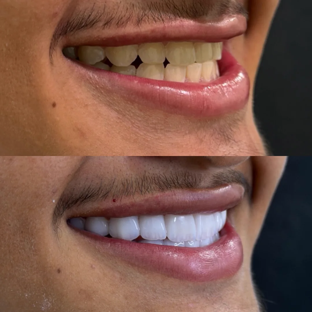 Comparativo de resultado odontológico antes e depois